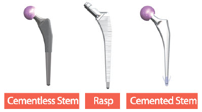 Corentec Bencox ID Stem