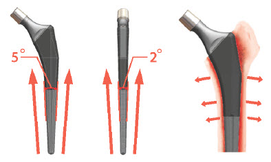 Corentec Bencox ID Stem