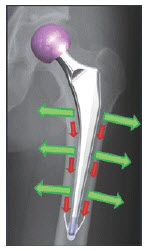 Corentec Bencox ID Cemented Stem